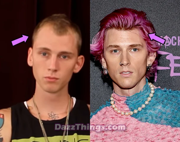 Machine Gun Kelly hair transplant before and after comparison photo