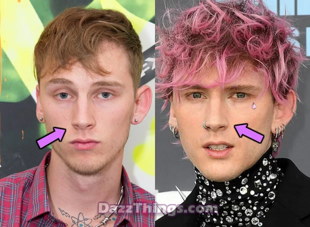 Machine Gun Kelly nose job before and after comparison photo