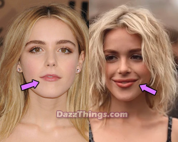 Kienan Shipka lip fillers before and after comparison photo