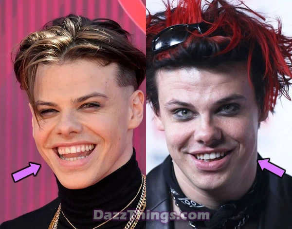 Yungblud botox before and after comparison photo