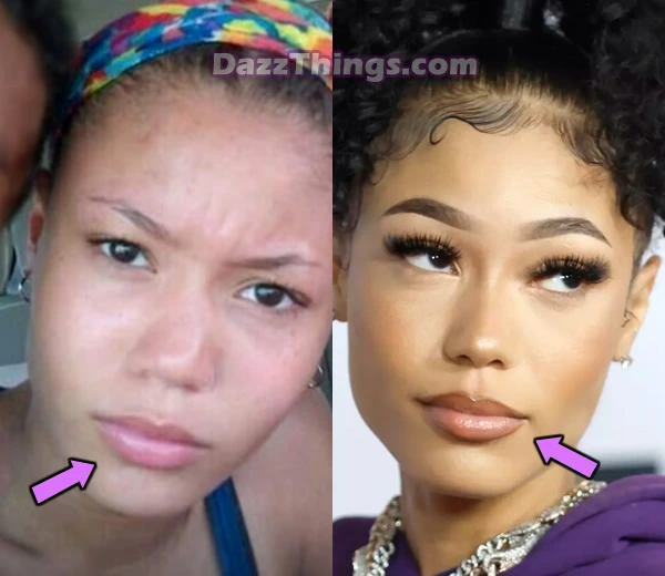 Coi Leray lip fillers before and after comparison photo