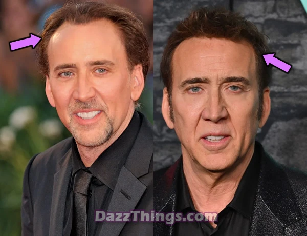 Nicolas Cage hair transplant before and after comparison photo