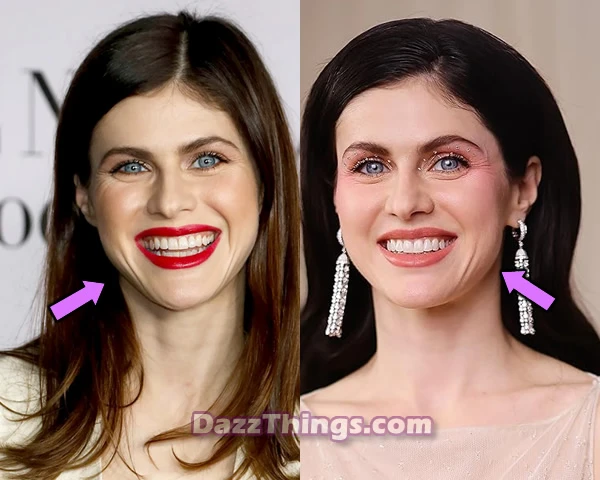 Alexandra Daddario botox before and after comparison photo
