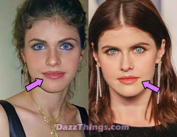 Alexandra Daddario lips before and after comparison photo