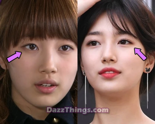 Bae Suzy eyelid surgery before and after comparison photo