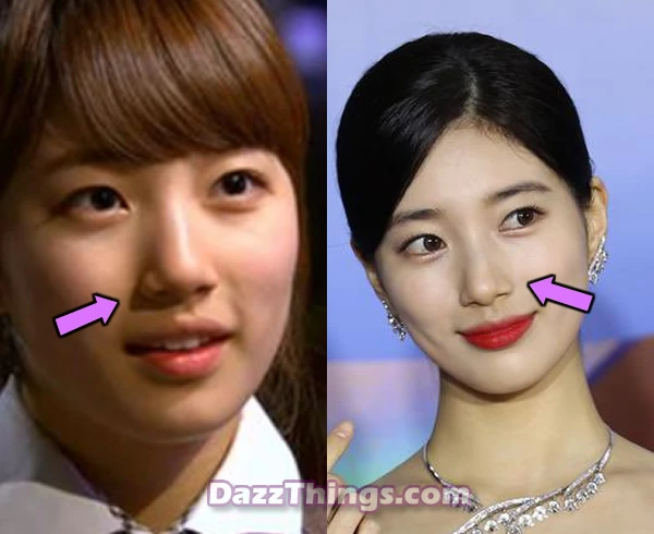 Bae Suzy nose job before and after comparison photo