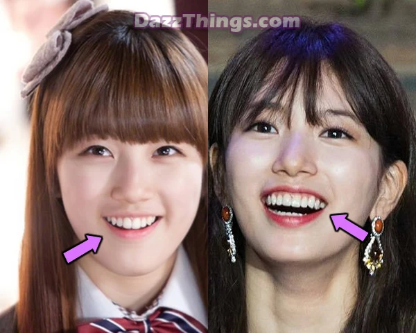 Bae Suzy teeth before and after comparison photo