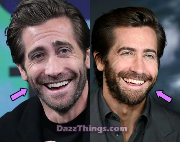 Jake Gyllenhaal botox before and after comparison photo