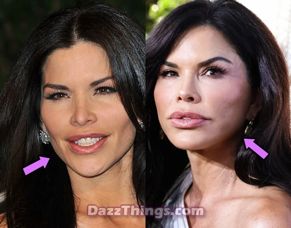 Lauren Sanchez botox before and after comparison photo