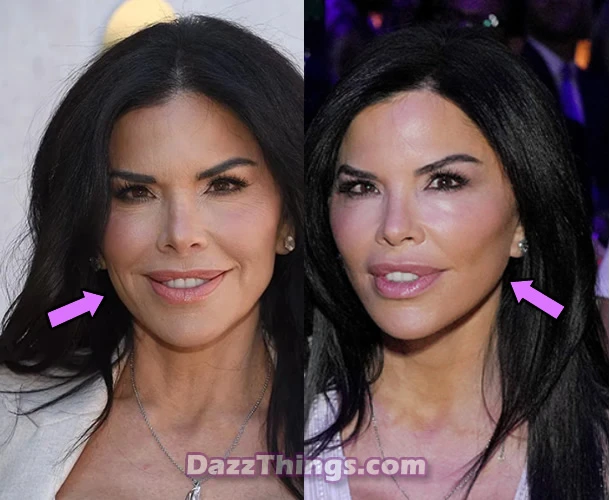 Lauren Sanchez facelift before and after comparison photo