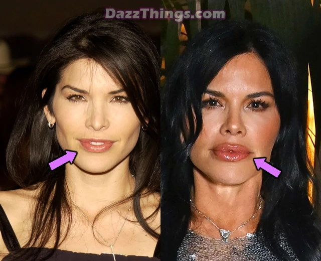 Lauren Sanchez lip fillers before and after comparison photo