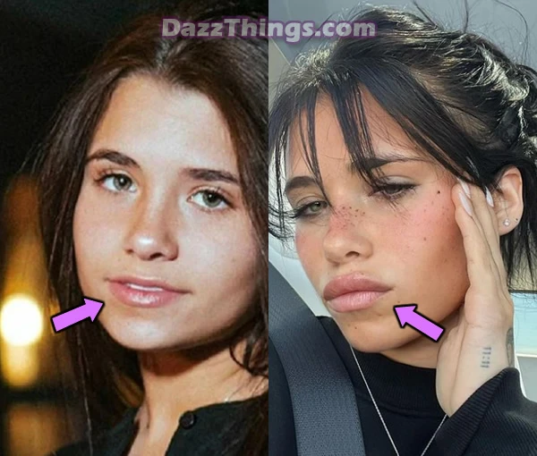 essa Barrett lip fillers before and after comparison photo