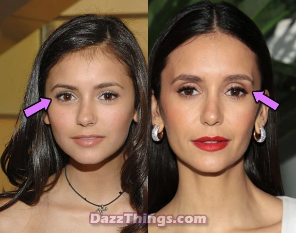 Nina Dobrev eyelids before and after comparison photo