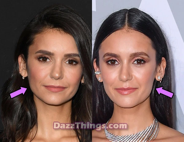 Nina Dobrev facelift before and after comparison photo