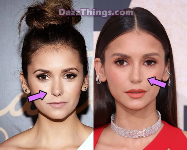 Nina Dobrev nose job before and after comparison photo