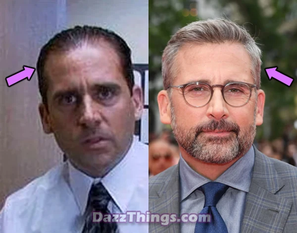 Steve Carell hair transplant before and after photo comparison