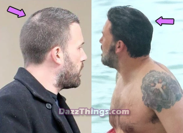 Ben Affleck hair transplant before and after comparison photo