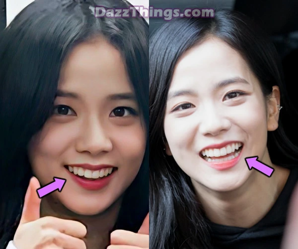 Blackpink Jisoo teeth before and after comparison photo