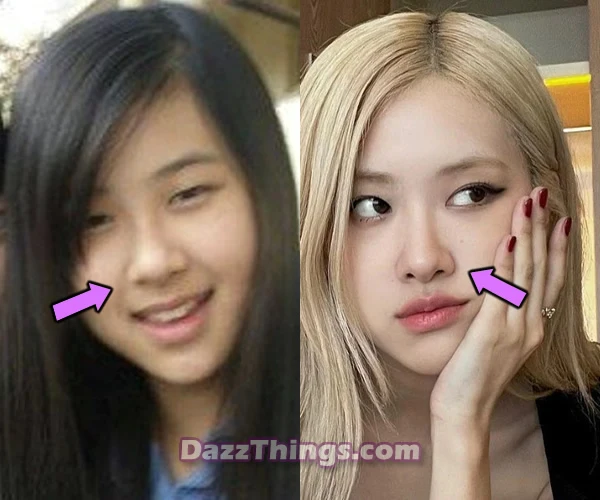 Blackpink Rose nose before and after comparison photo