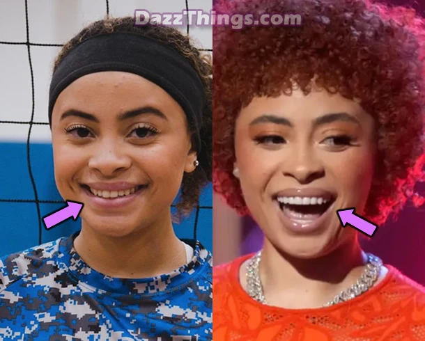 Ice Spice teeth before and after photo comparison