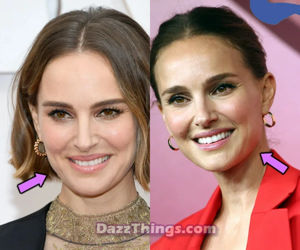 Natalie Portman botox before and after photo comparison