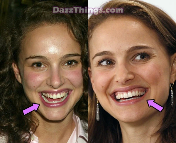 Natalie Portman teeth before and after photo comparison